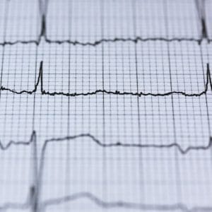 ekg