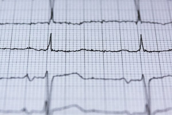 ekg