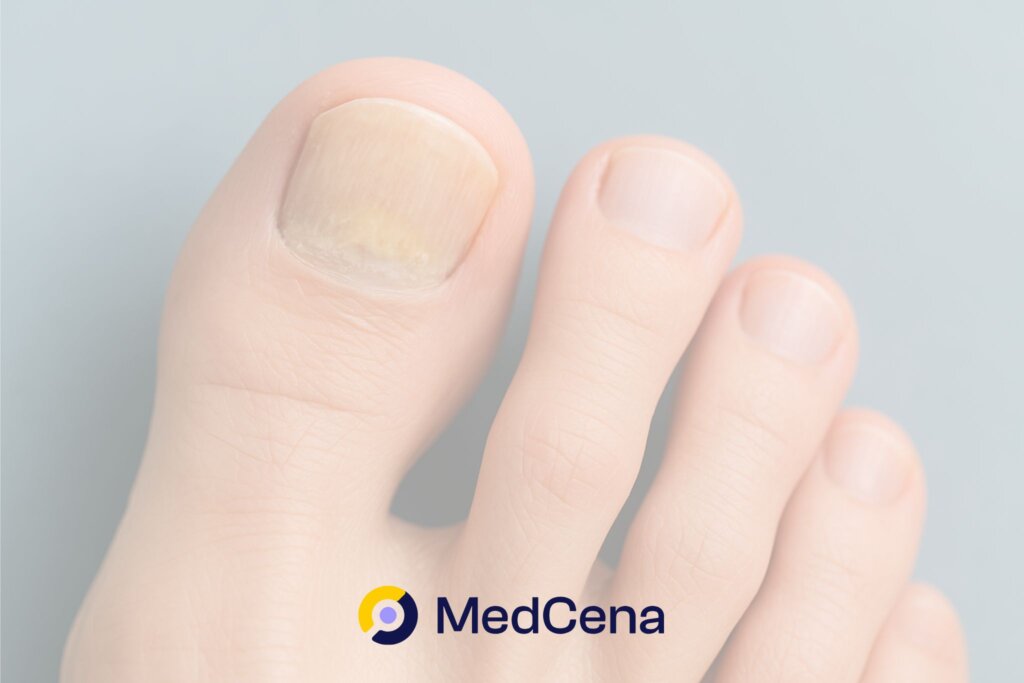 Grzybica paznokci domowy sposób na forum MedCena