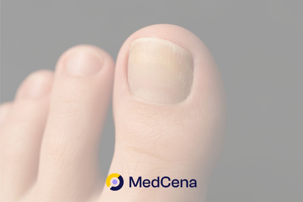 Grzybica paznokci wyleczona forum MedCena