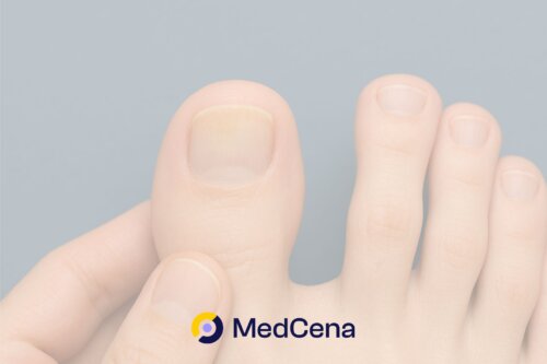 Wyleczyłam grzybicę paznokci forum MedCena