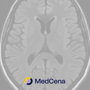 Guz mózgu – forum, pierwsze objawy guza mózgu