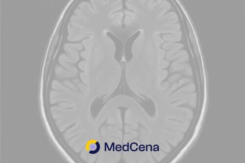 Guz mózgu – forum, pierwsze objawy guza mózgu